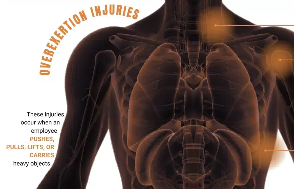 Overexertion injury diagram showing workplace strain covered by workers' comp
