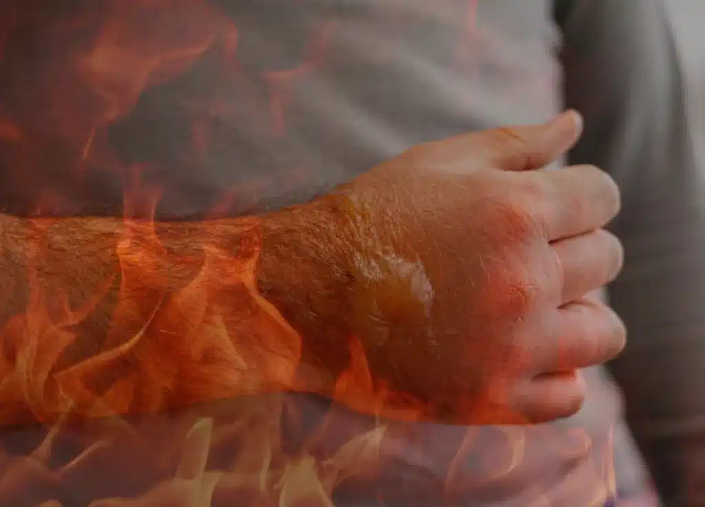 Close-up of a severe skin burn injury with blistering on a person's hand and wrist, visually representing product liability and negligent service lawsuits.