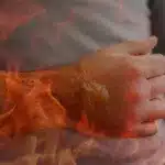 burn injury victim